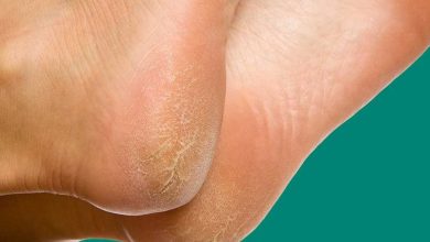 استخدمي العسل.. حيل لعلاج تشققات الكعبين